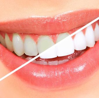 Affordable Teeth Whitening